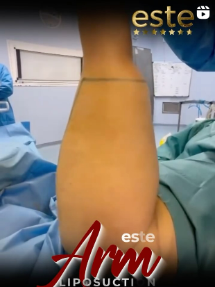 Arm Liposuction