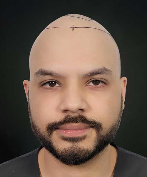 Hair Transplant